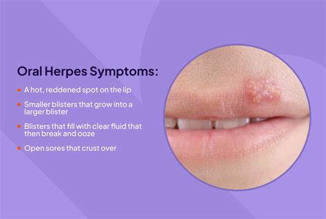 herpes on virgin|what is a genital herpes infection.